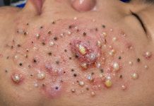 Cystic Acne Blackheads Extraction