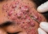 Cystic Blackheads Extraction Removal