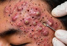 Cystic Blackheads Extraction Removal