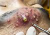 Big Cystic Blackheads Extraction
