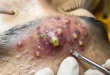 Big Cystic Blackheads Extraction