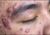 Blackheads Extraction Blackheads