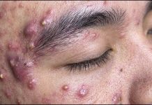 Blackheads Extraction Blackheads