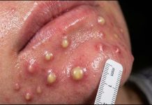 Blackheads Extraction Whiteheads