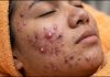 Acne Blackheads Extraction