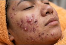 Acne Blackheads Extraction