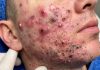 Acne Blackheads Extraction