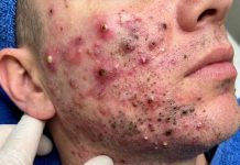 Acne Blackheads Extraction