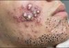 Acne Blackheads Whiteheads