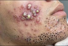 Acne Blackheads Whiteheads