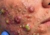 Acne Blackheads Extraction Whiteheads