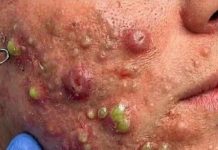 Acne Blackheads Extraction Whiteheads