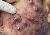 Cystic Acne Blackheads Extraction