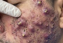 Cystic Acne Blackheads Extraction