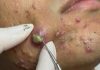 Big Cystic Acne Blackheads Extraction