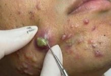 Big Cystic Acne Blackheads Extraction