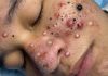 Acne Blackheads Extraction