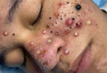 Acne Blackheads Extraction