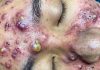 Cystic Acne Blackheads Whiteheads