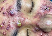 Cystic Acne Blackheads Whiteheads