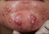 Blackheads Extraction Removal