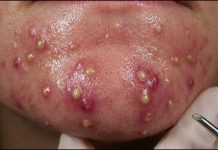Blackheads Extraction Removal