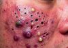 Acne Blackheads Extraction
