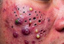 Acne Blackheads Extraction