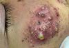 Big Blackheads Extraction Whiteheads