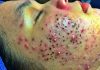 Acne Blackheads Extraction