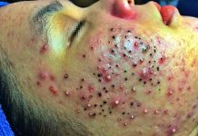 Acne Blackheads Extraction