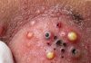 Blackheads Extraction Whiteheads