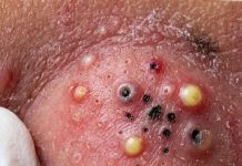 Blackheads Extraction Whiteheads