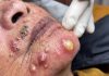 Blackheads Extraction Whiteheads