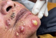 Blackheads Extraction Whiteheads