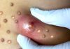 Big Cystic Blackheads Extraction
