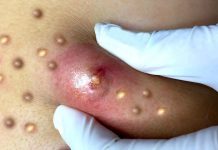 Big Cystic Blackheads Extraction