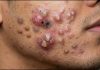 Big Cystic Blackheads Extraction