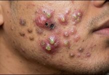 Big Cystic Blackheads Extraction