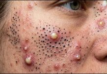 Acne Blackheads Whiteheads