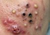 Blackheads Extraction