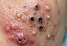 Blackheads Extraction