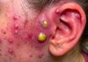 Blackheads Extraction Whiteheads