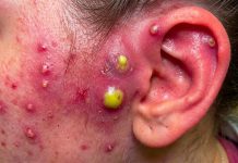 Blackheads Extraction Whiteheads