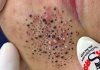 Blackheads Extraction