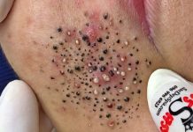 Blackheads Extraction