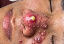 Cystic Blackheads Extraction Whiteheads