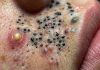 Blackheads Extraction