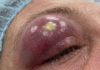 Blackheads Extraction