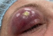 Blackheads Extraction